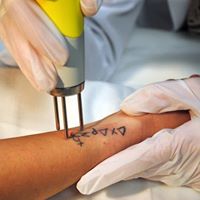 Gulf Coast Tattoo Removal