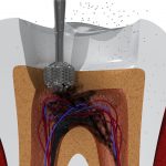 Purpose of Root Canal Treatment