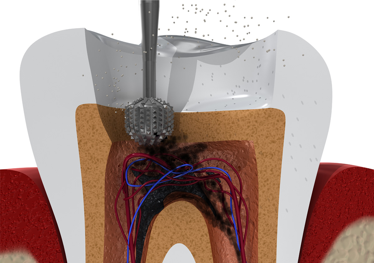 Dentist in central HK describes the purpose of root canal treatment