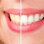 Teeth Whitening HK