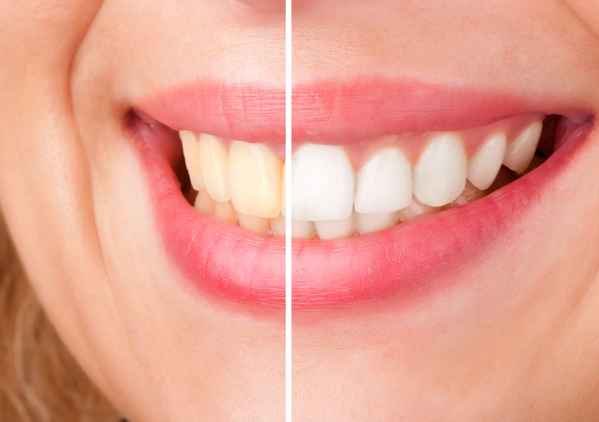 HK dentist explains the best options for teeth whitening
