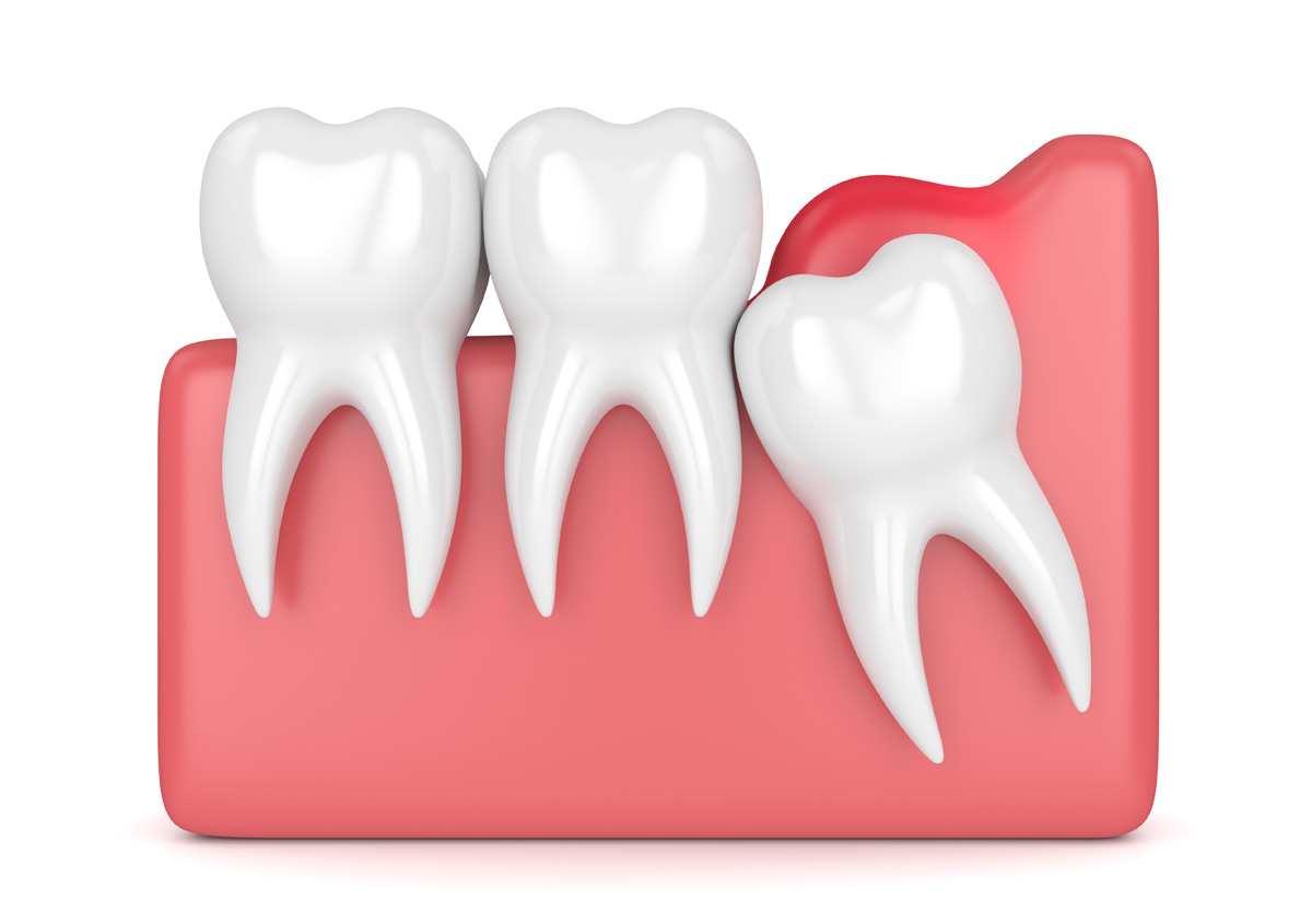 Signs It’s Time to Remove Wisdom Teeth