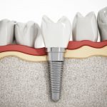 Teeth Implants Dentist San Jose CA