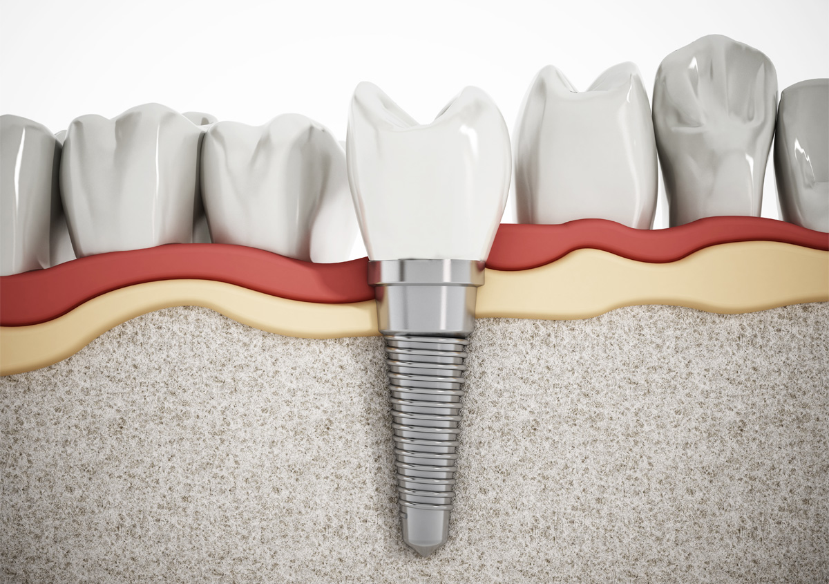 Services Offered by a Tooth Implant Dentist